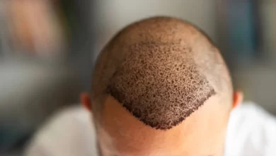 مراقبتهای بعد از کاشت مو