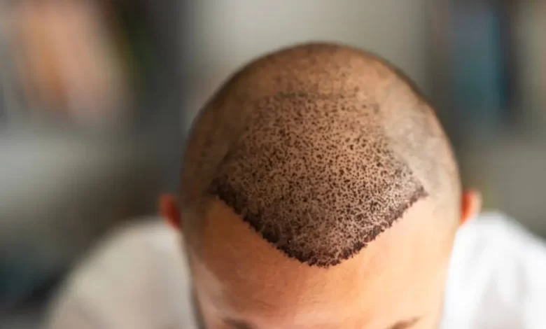 مراقبتهای بعد از کاشت مو